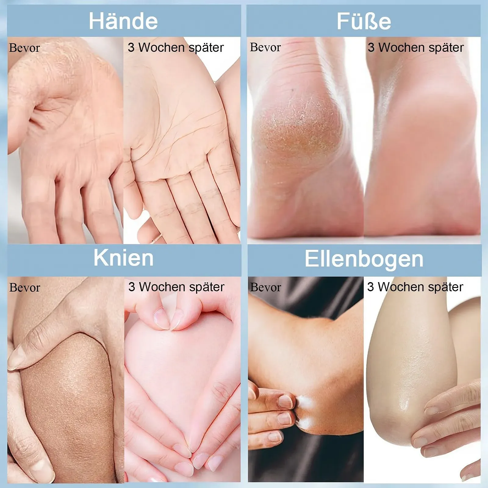 Крем для ног и рук с мочевиной 60% Увлажняющий От мозолей 100 мл, фото №5