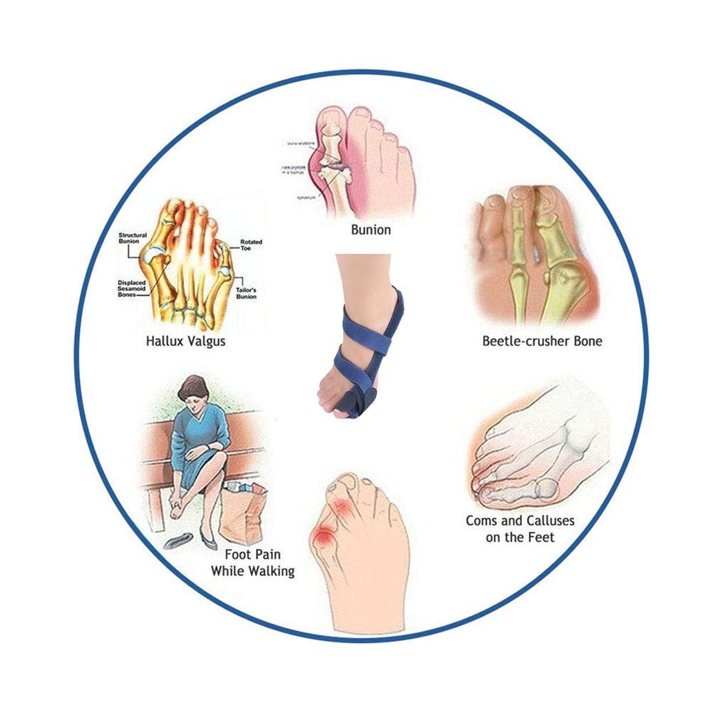 Роздільники для пальців ніг для денного та нічного полегшення болю при вальгусній деформації великого пальця стопи, фото №9