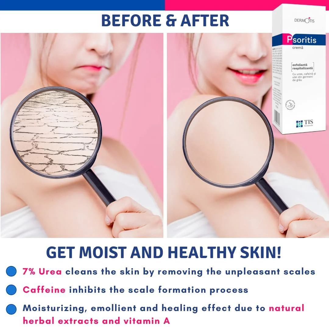 Крем PsoriTIS 7% Сечовина - Екзема, кератоз, псоріаз, для сухої, потовщеної, потрісканої шкіри тіла - ступні, лікті, коліна, руки, кофеїн Вітамін A, фото №4