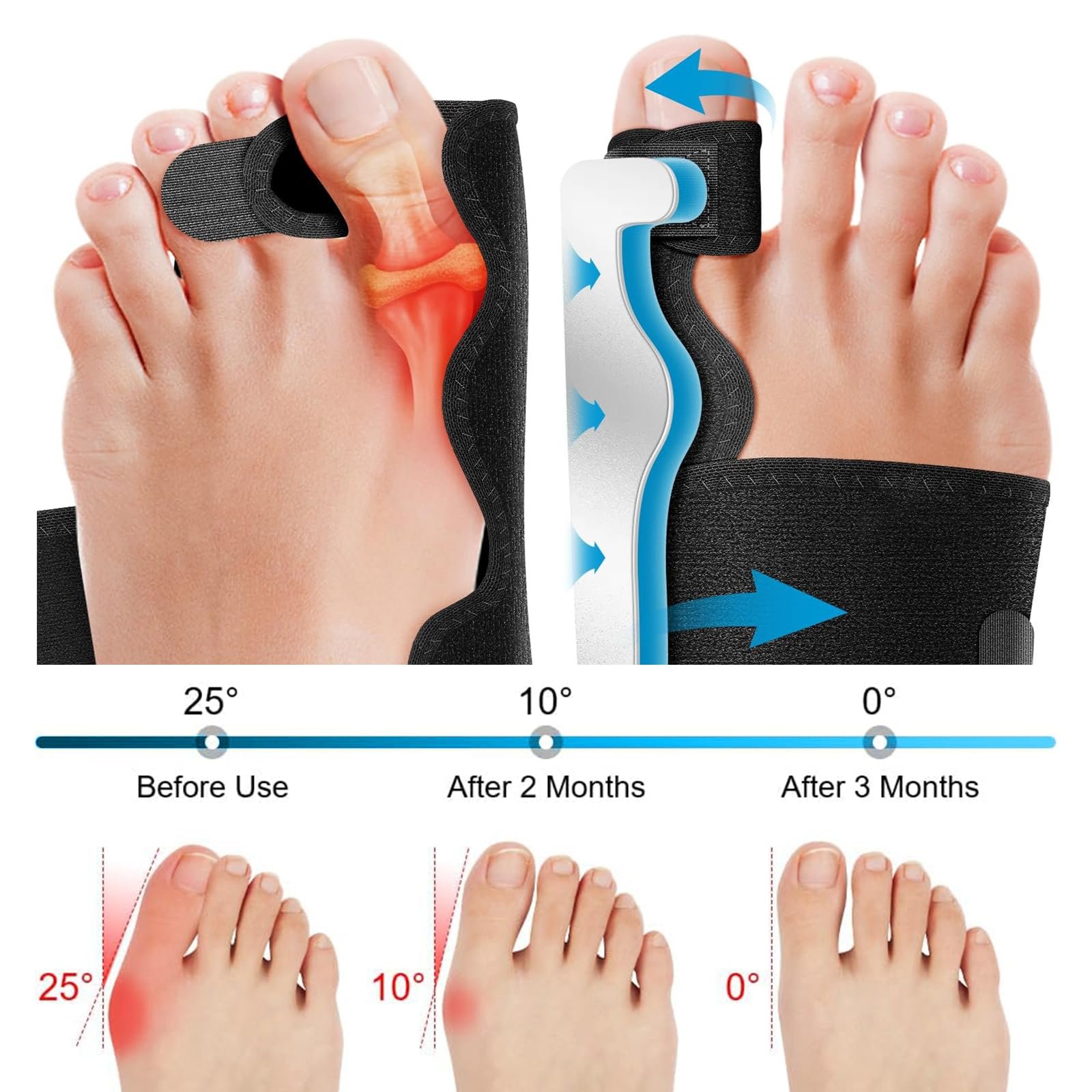 Шина для коррекции Hallux Valgus Регулируемая Облегчение боли и защита Корректирующая, фото №2