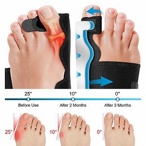 Шина для коррекции Hallux Valgus Регулируемая Облегчение боли и защита Корректирующая synthetic.ua - Фото 1