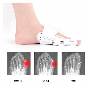 Корректор большого пальца стопы TILEZE, разделитель пальцев, протектор, молотковидных пальцев, облегчение при бурсите, ортопедический synthetic.ua - Фото 1