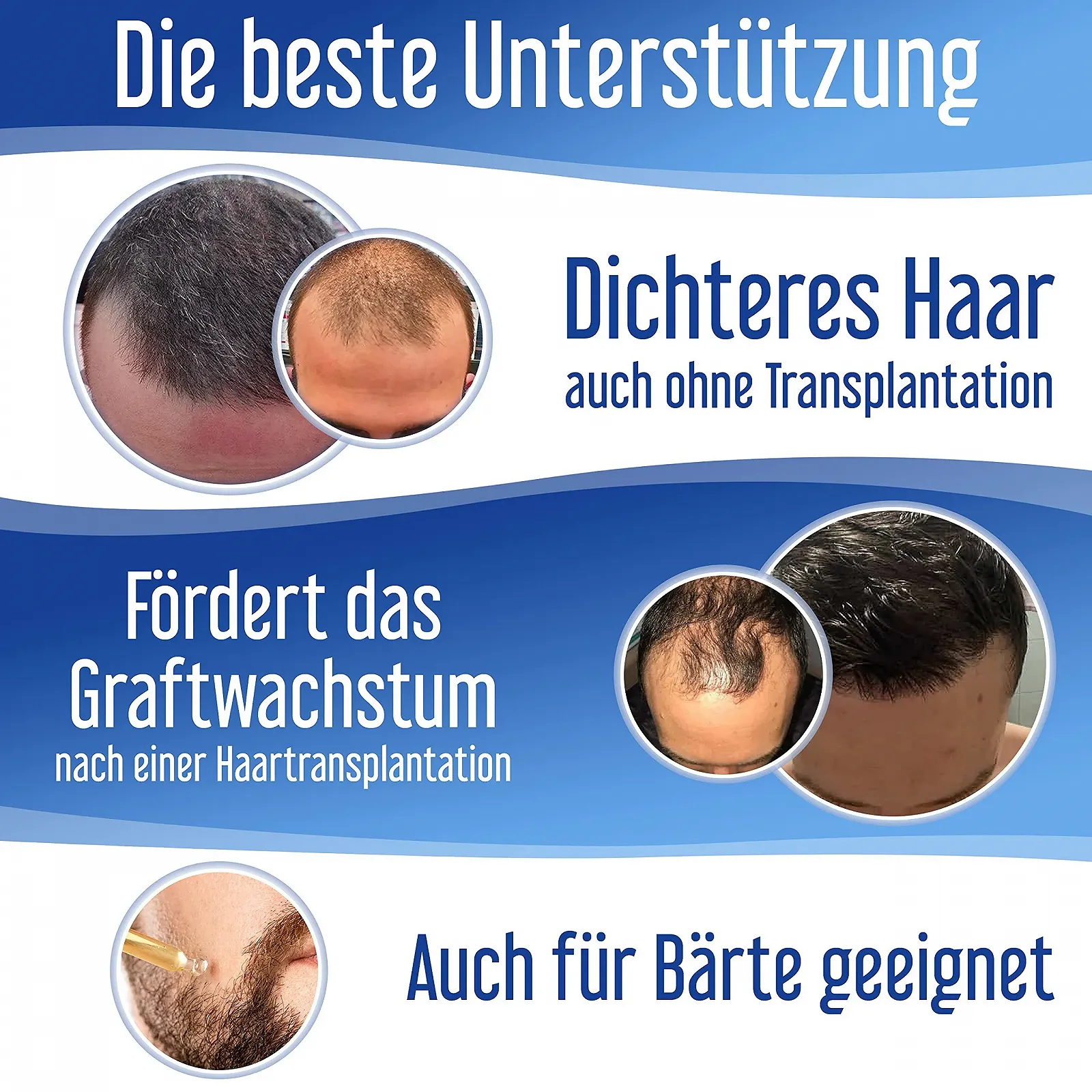 Спрей Hairforte 3% Procapil против выпадения волос, блокатор DHT, фото №5