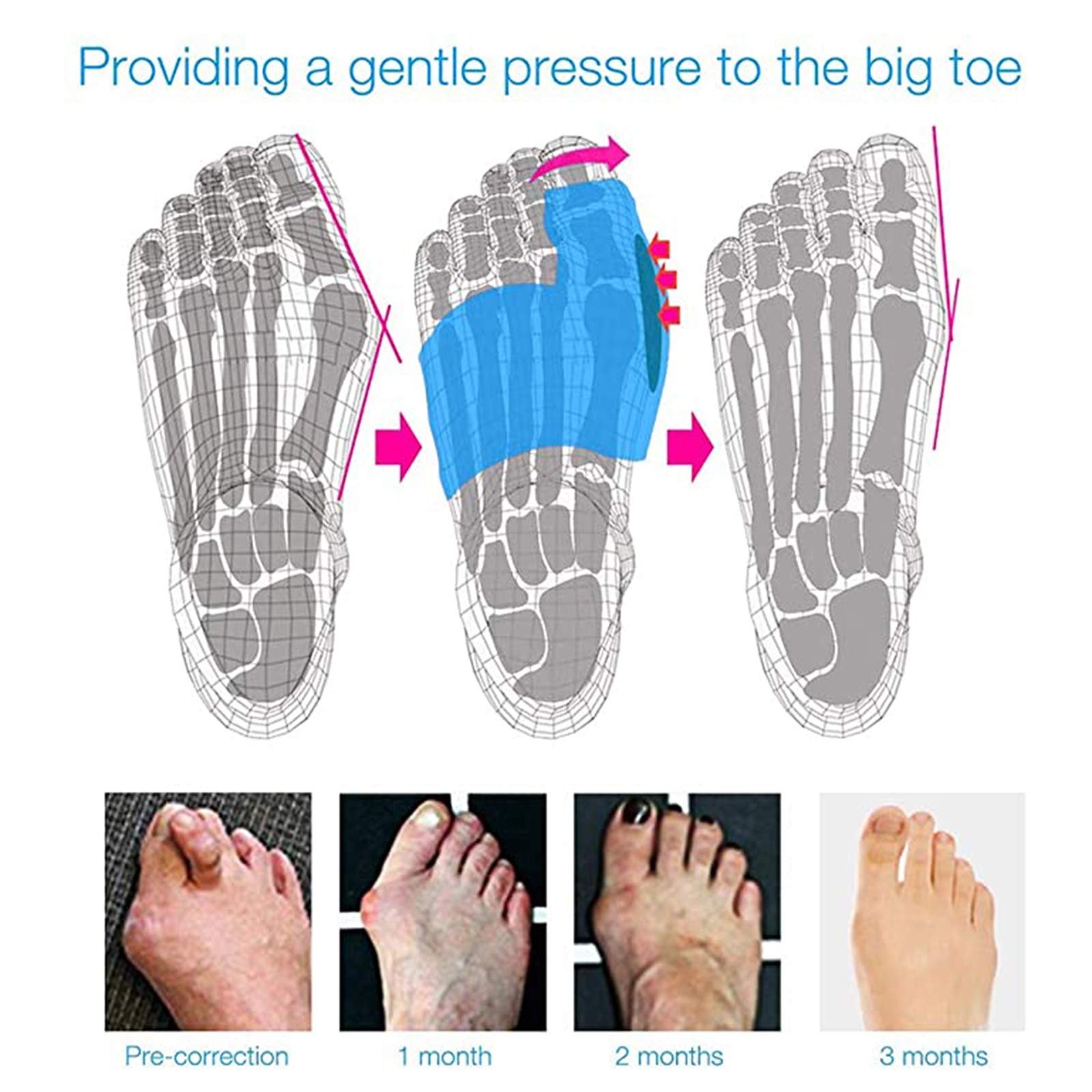 Коректор великого пальця стопи пневматичний Valgus Corrector з регульованим тиском повітря, шина денна та нічна / 1 пара, рожевий, фото №3