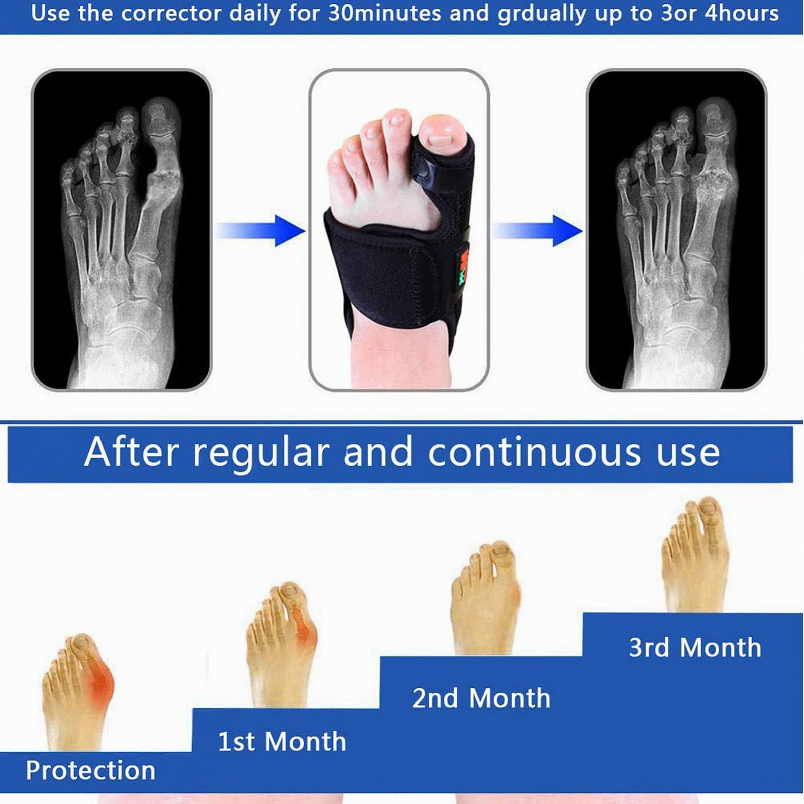 Коректор великого пальця стопи Hallux Valgus, ортопедичний випрямляч, Hallux Valgus для пальців ніг, фото №5 Коректор великого пальця стопи Hallux Valgus, ортопедичний випрямляч, Hallux Valgus для пальців ніг, фото №5