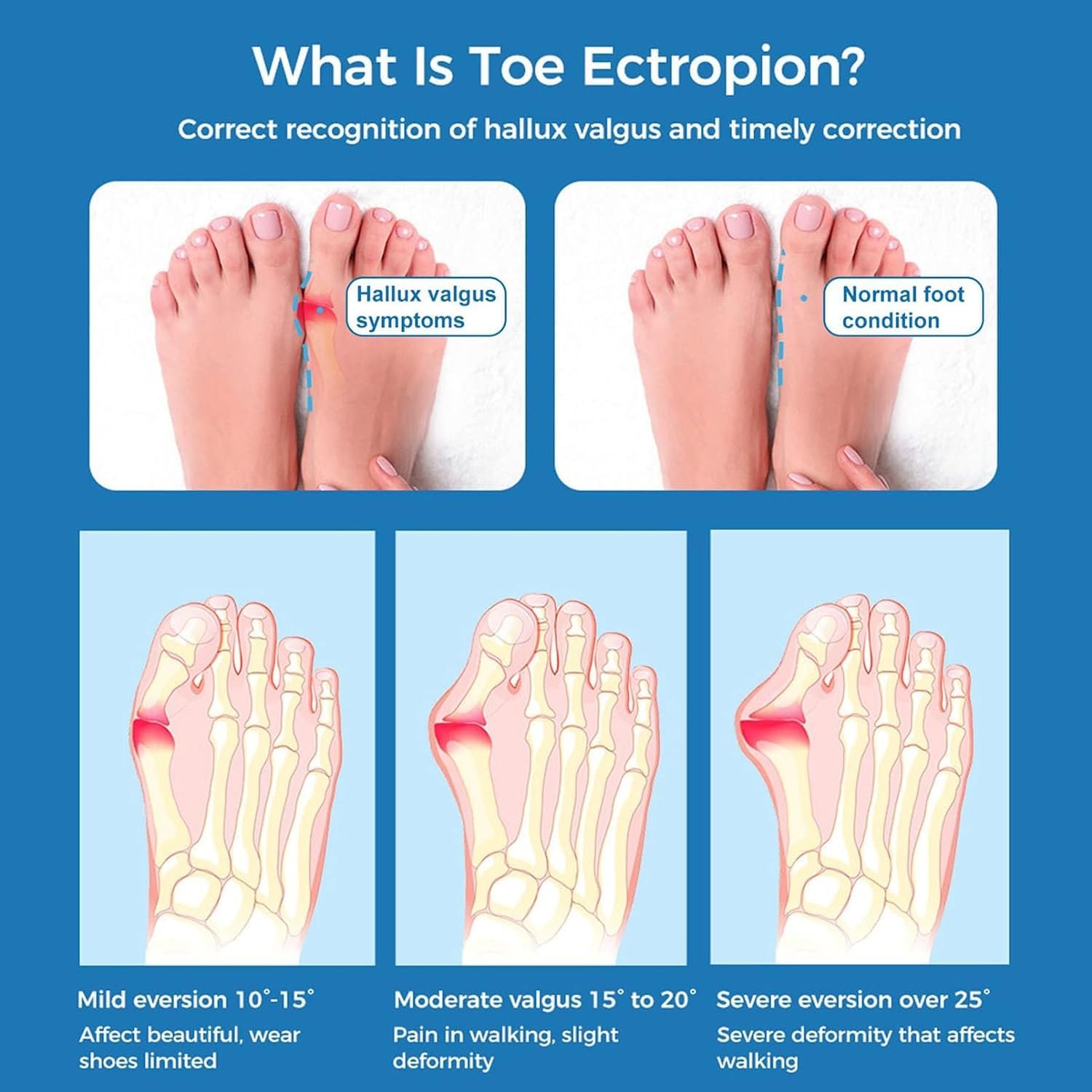 Розпірка великого пальця стопи для чоловіків і жінок, 1 пара, коректор вальгусної деформації, регульована, фото №8