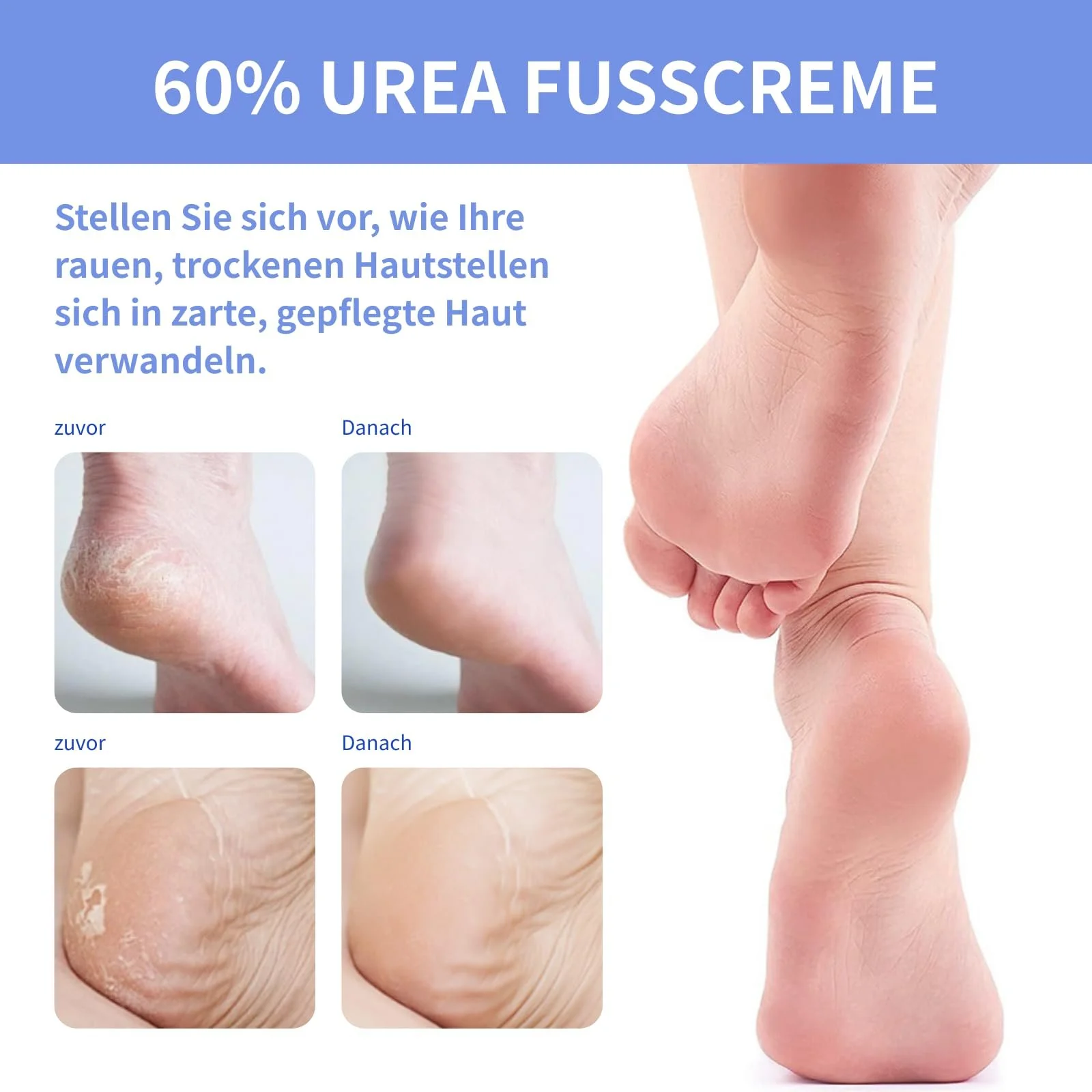 Крем для ног Urea 60% для очень сухой и потрескавшейся кожи стоп и рук увлажняющий, фото №6