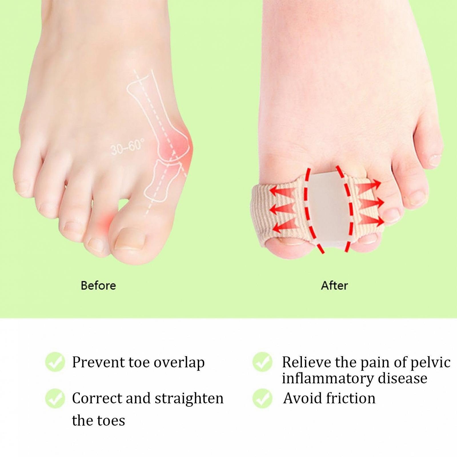 Корректор большого пальца стопы (Hallux Valgus) Силиконовый, 4 шт. Размер L, фото №7 Корректор большого пальца стопы (Hallux Valgus) Силиконовый, 4 шт. Размер L, фото №7