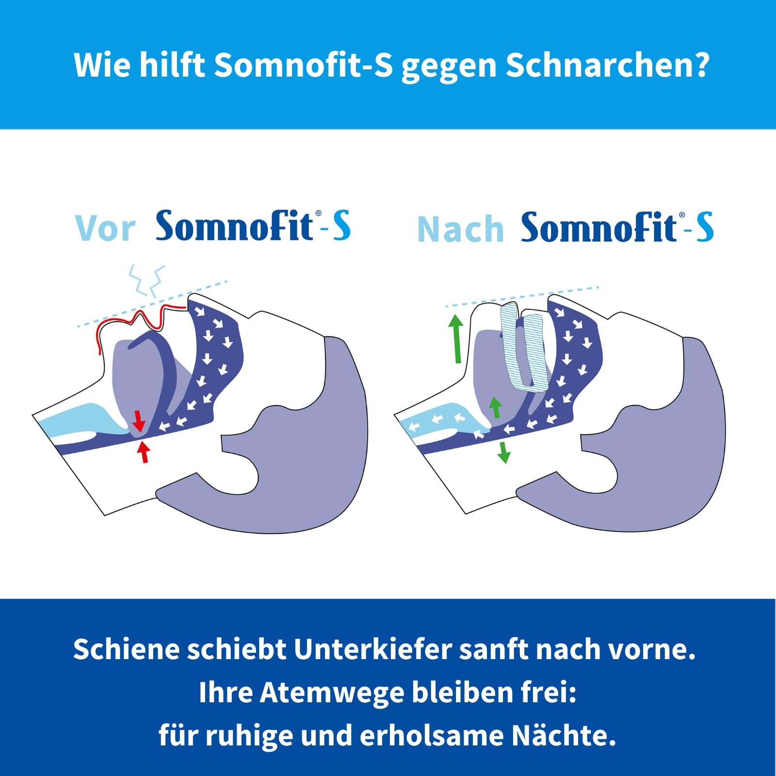 Ротова скоба від хропіння High-End S, фото №4