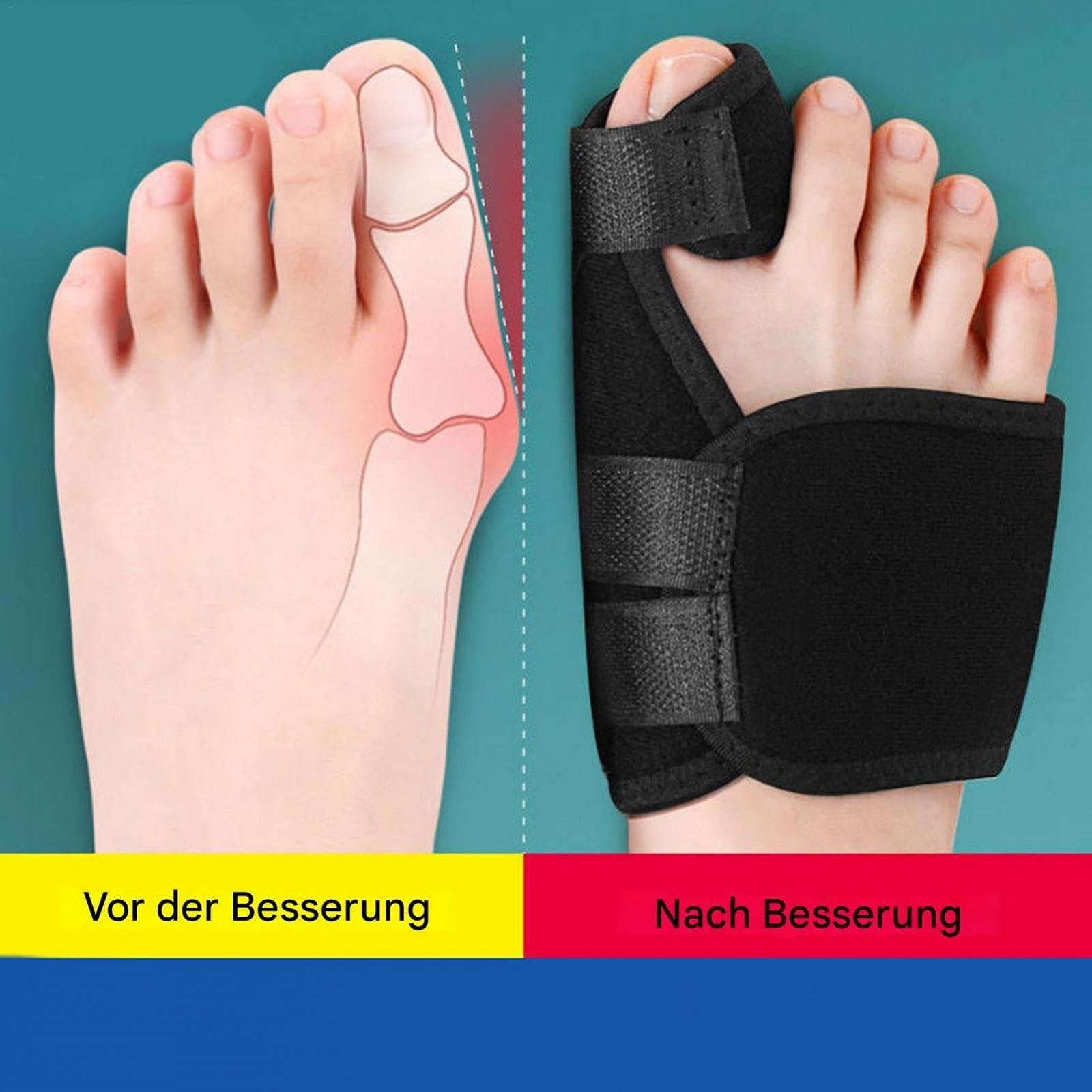 Шина для великого пальця ноги при переломі, Hallux Valgus Corrector, набір 2 шт, фото №6