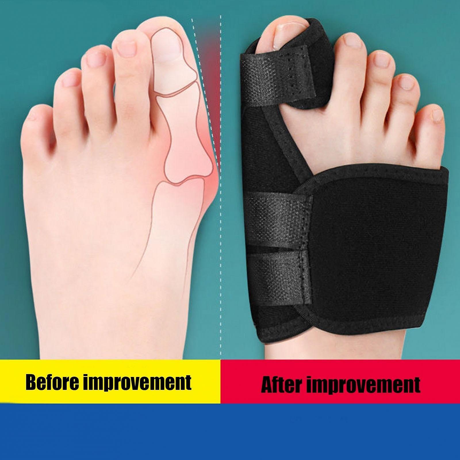 Шина для великого пальця стопи Amala, Коректор Hallux Valgus, 2 шт., Коректор, фото №9 Шина для великого пальця стопи Amala, Коректор Hallux Valgus, 2 шт., Коректор, фото №9