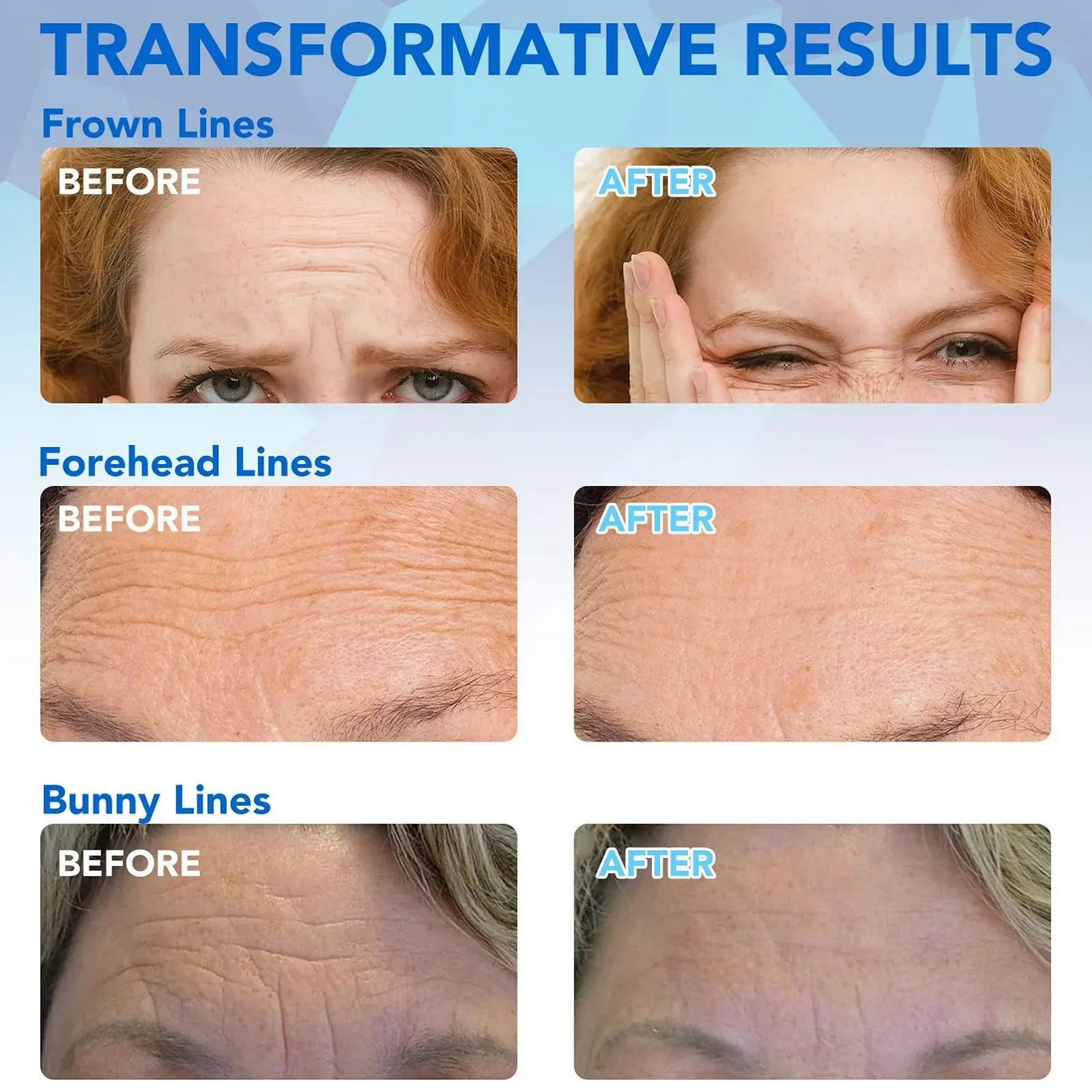 Пластирі Meitrend проти зморшок, антивікові, 16 штук з гіалуроном, фото №2