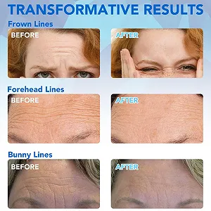 Пластыри Meitrend против морщин, антивозрастные, 16 штук с гиалуроном цена на synthetic.ua - Фото 1 Пластыри Meitrend против морщин, антивозрастные, 16 штук с гиалуроном synthetic.ua - Фото 1