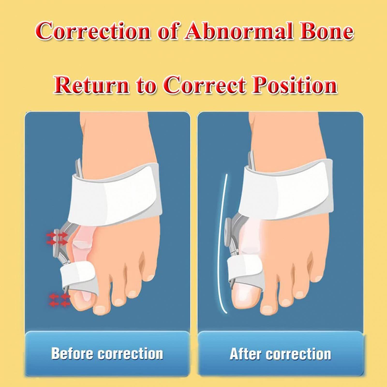 Коректор великого пальця стопи, випрямляч, вальгусної деформації, регульована кнопка з силіконовою внутрішньою підкладкою, підтримка вдень і вночі, фото №5