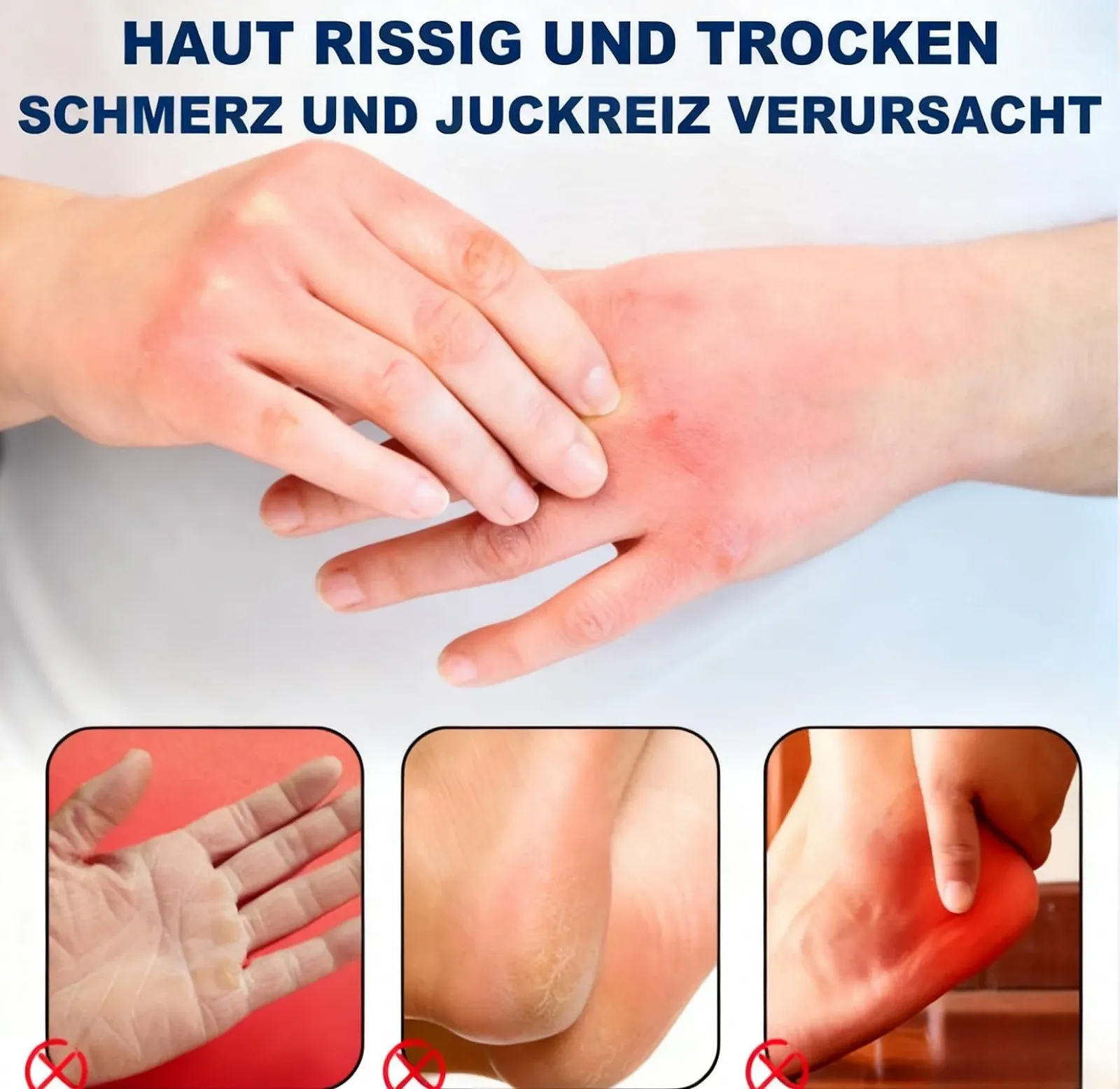 Крем Urea Cream с мочевиной 60% и салициловой кислотой 2% против мозолей, фото №4 Крем Urea Cream с мочевиной 60% и салициловой кислотой 2% против мозолей, фото №4