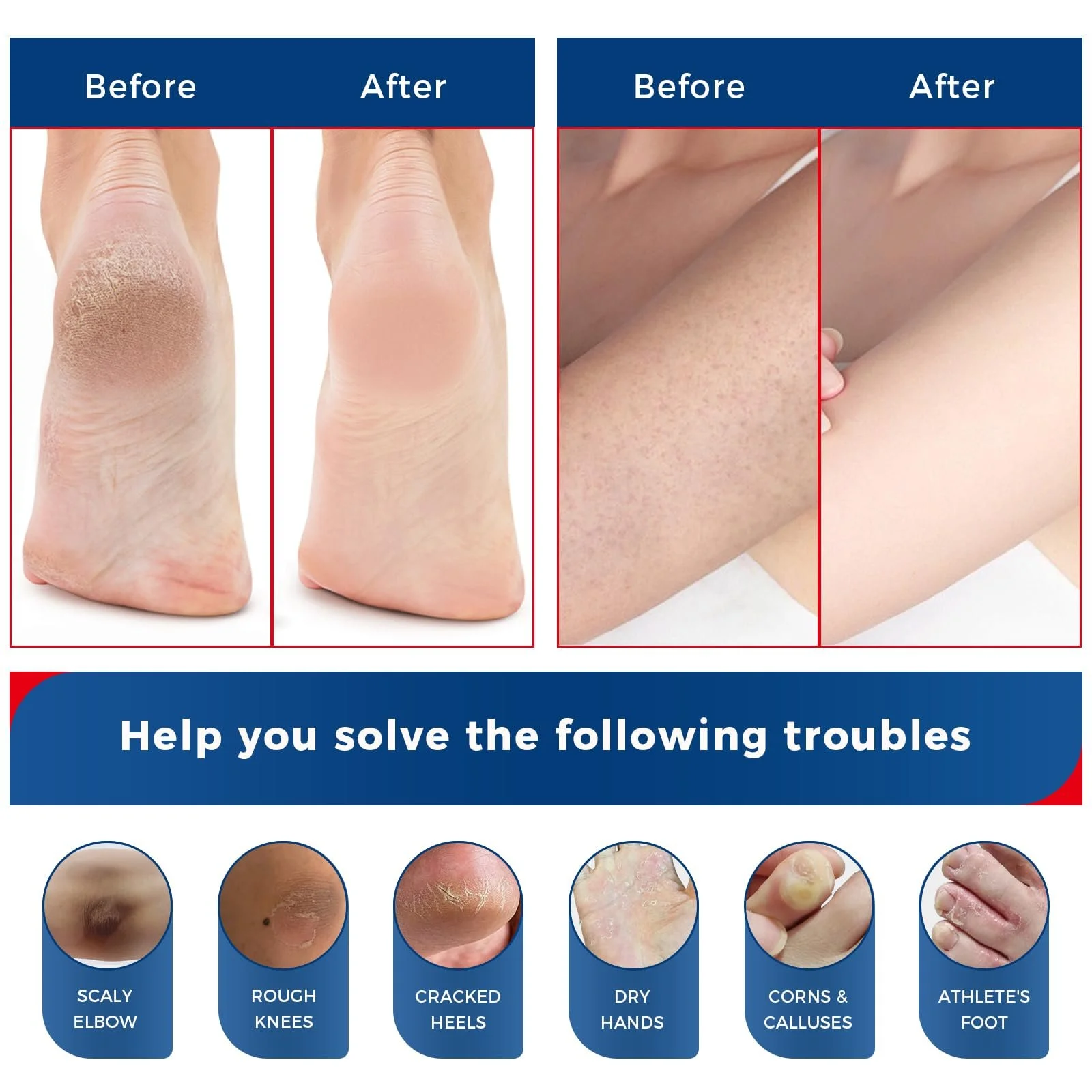 Крем для ног и рук OUKEYA Formula Urea Cream 40% Plus Salicylic Acid 2% увлажняющий и восстанавливающий, фото №6