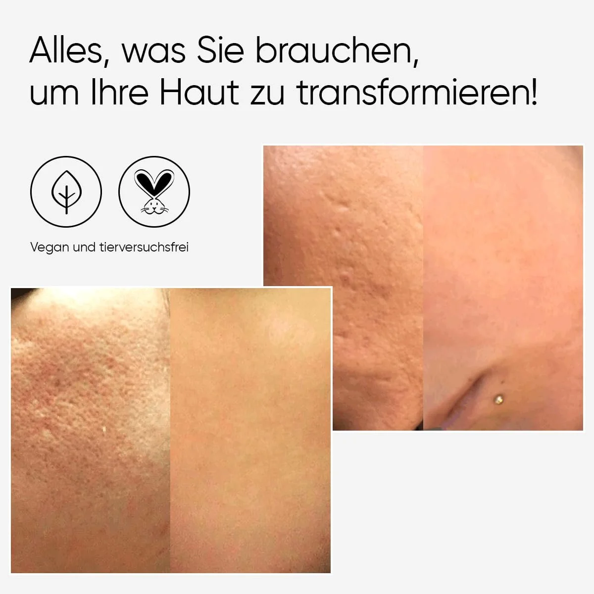 Ролер для обличчя Ame Pure CIT Basic Set, 100% натуральна мікроголкова обробка, фото №4