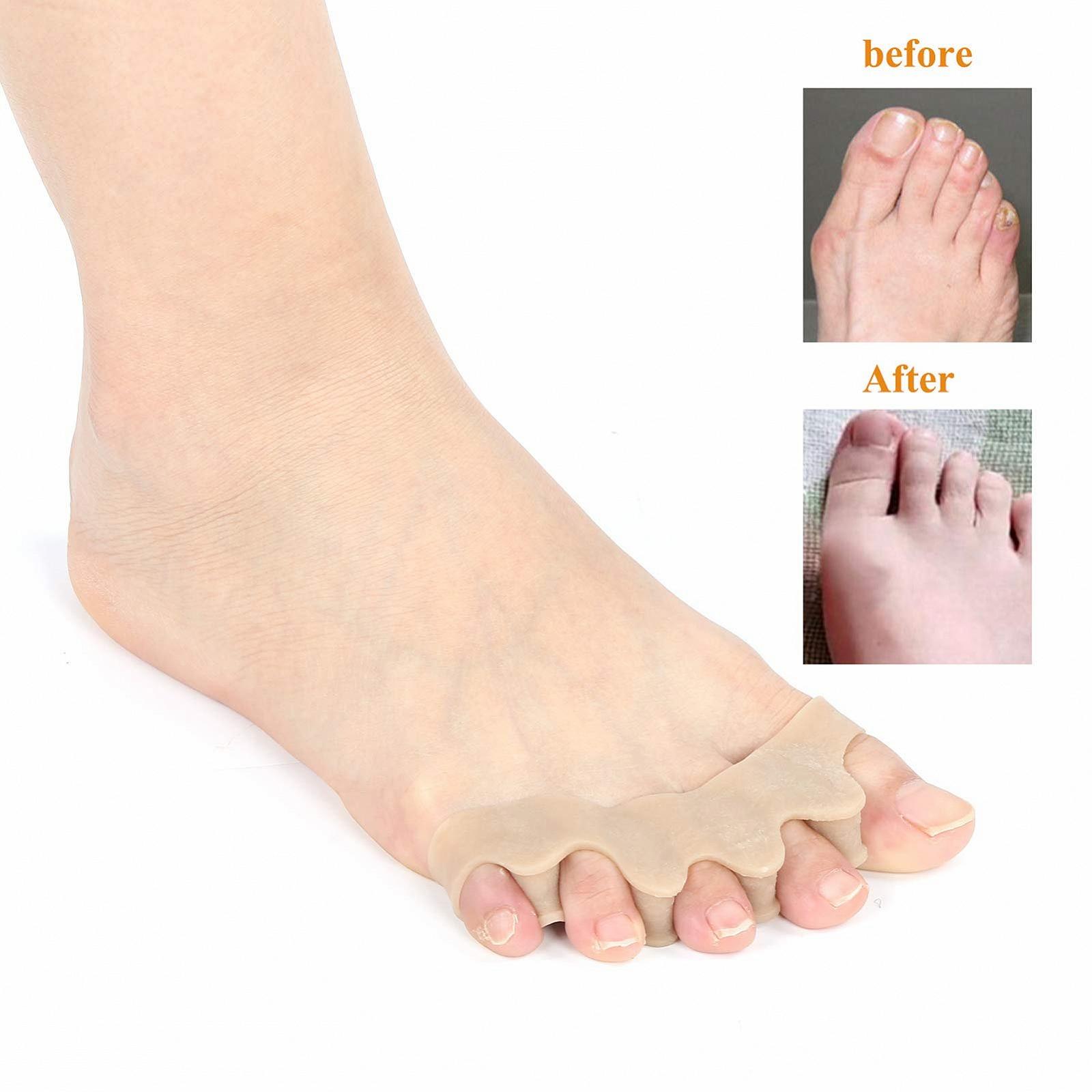 Коректор великого пальця стопи Hallux Valgus Унісекс Силіконовий роздільник для пальців ніг, фото №6