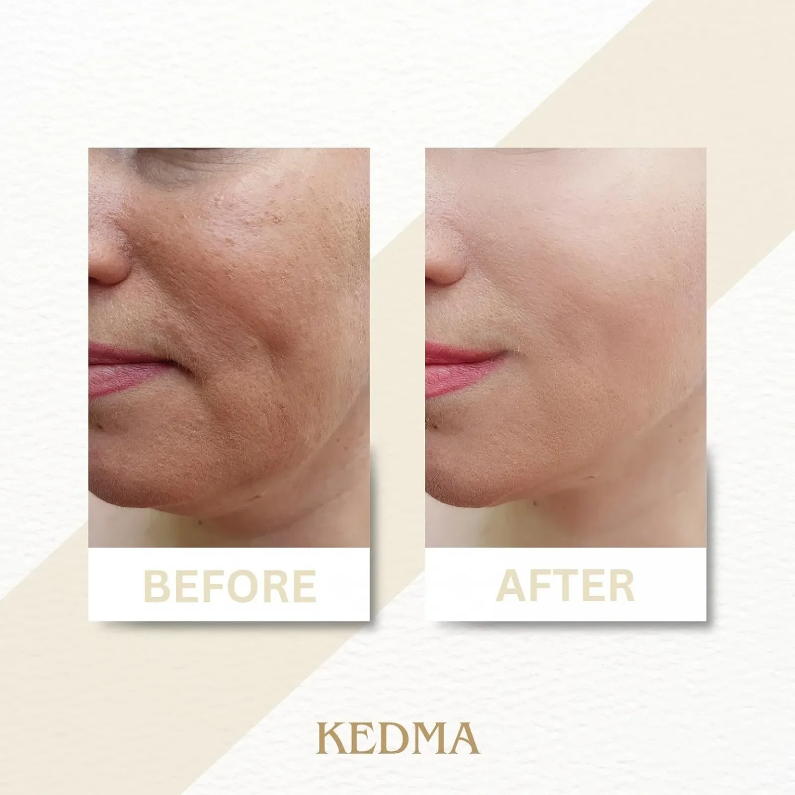 Набор для ухода за руками и ногами Kedma на основе минералов Мертвого моря Увлажняющий и питательный 2 x 100 г, фото №5 Набор для ухода за руками и ногами Kedma на основе минералов Мертвого моря Увлажняющий и питательный 2 x 100 г, фото №5