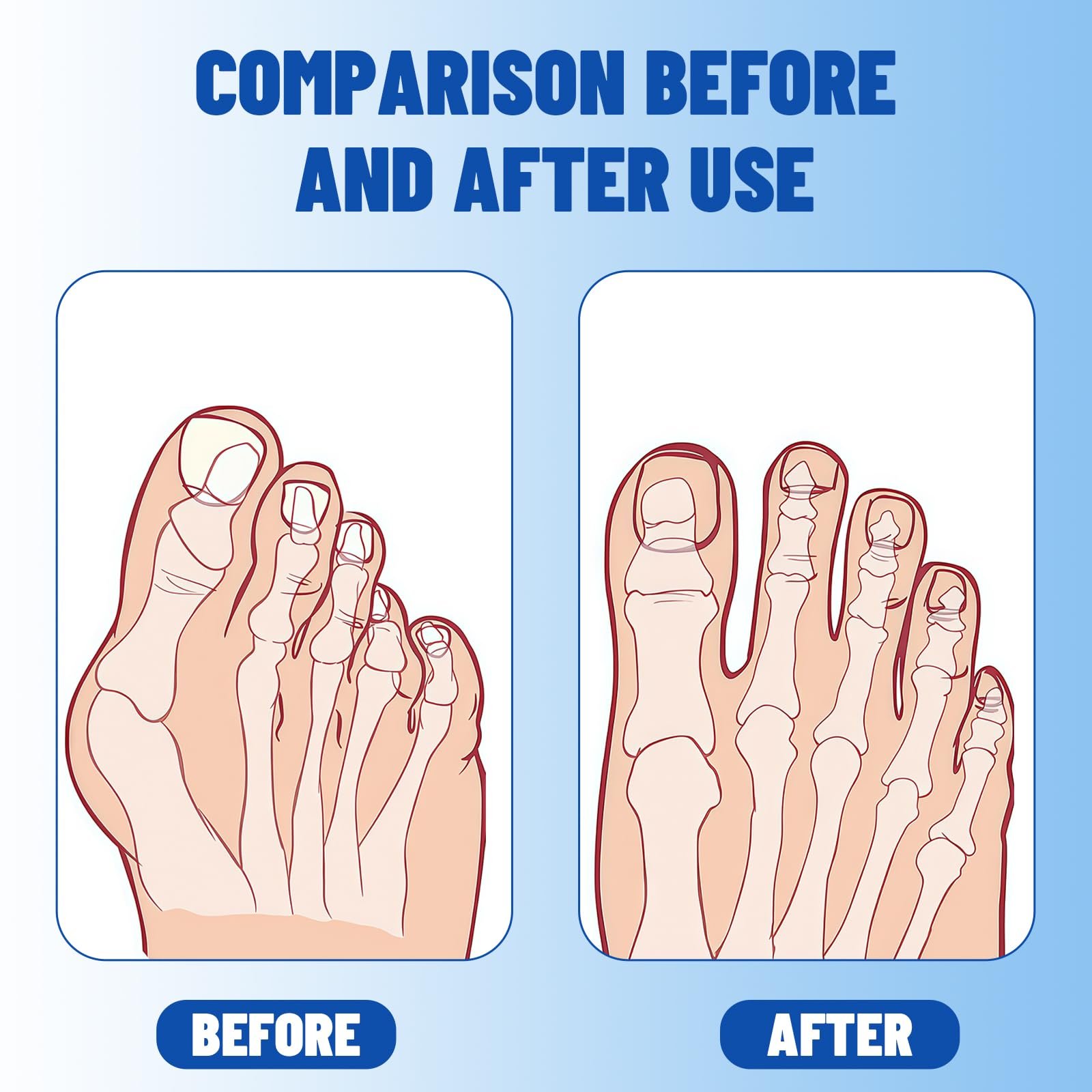 Носки для коррекции Hallux Valgus, 1 пара, с гелевой подушкой, фото №5 Носки для коррекции Hallux Valgus, 1 пара, с гелевой подушкой, фото №5