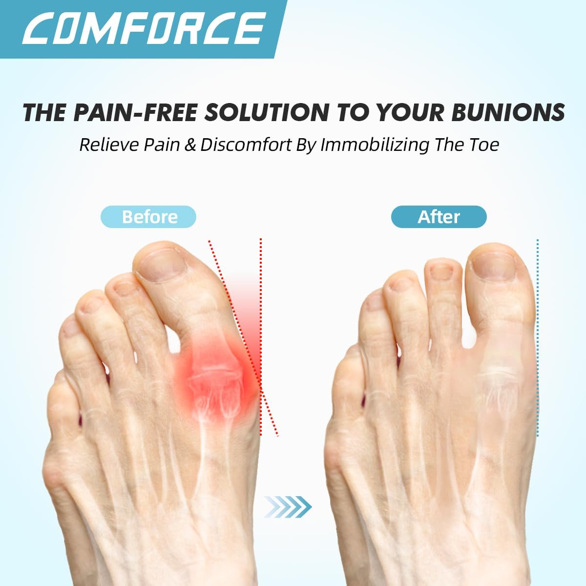 Коректор великого пальця стопи Hallux Valgus, 2 шт., Ультратонкий випрямляч, фото №7