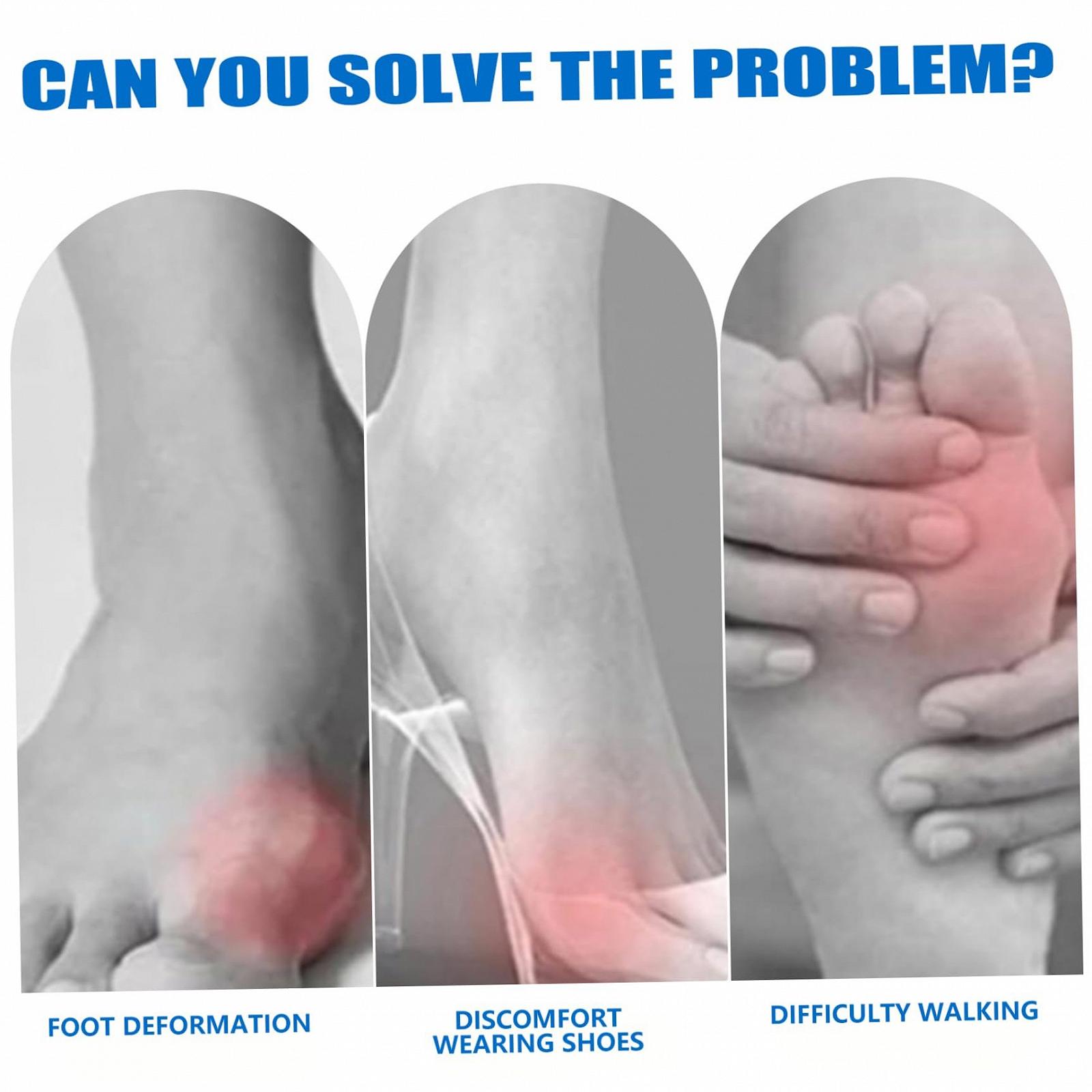 Корректор большого пальца стопы NIDONE Регулируемый Удобный для левой и правой ноги Облегчение боли при вальгусной деформации большого пальца стопы, фото №8