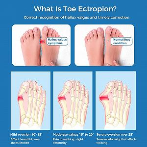 Коректор Вальгусної Деформації (2 шт.) Регульований Розмір для Чоловіків та Жінок synthetic.ua - Фото 1