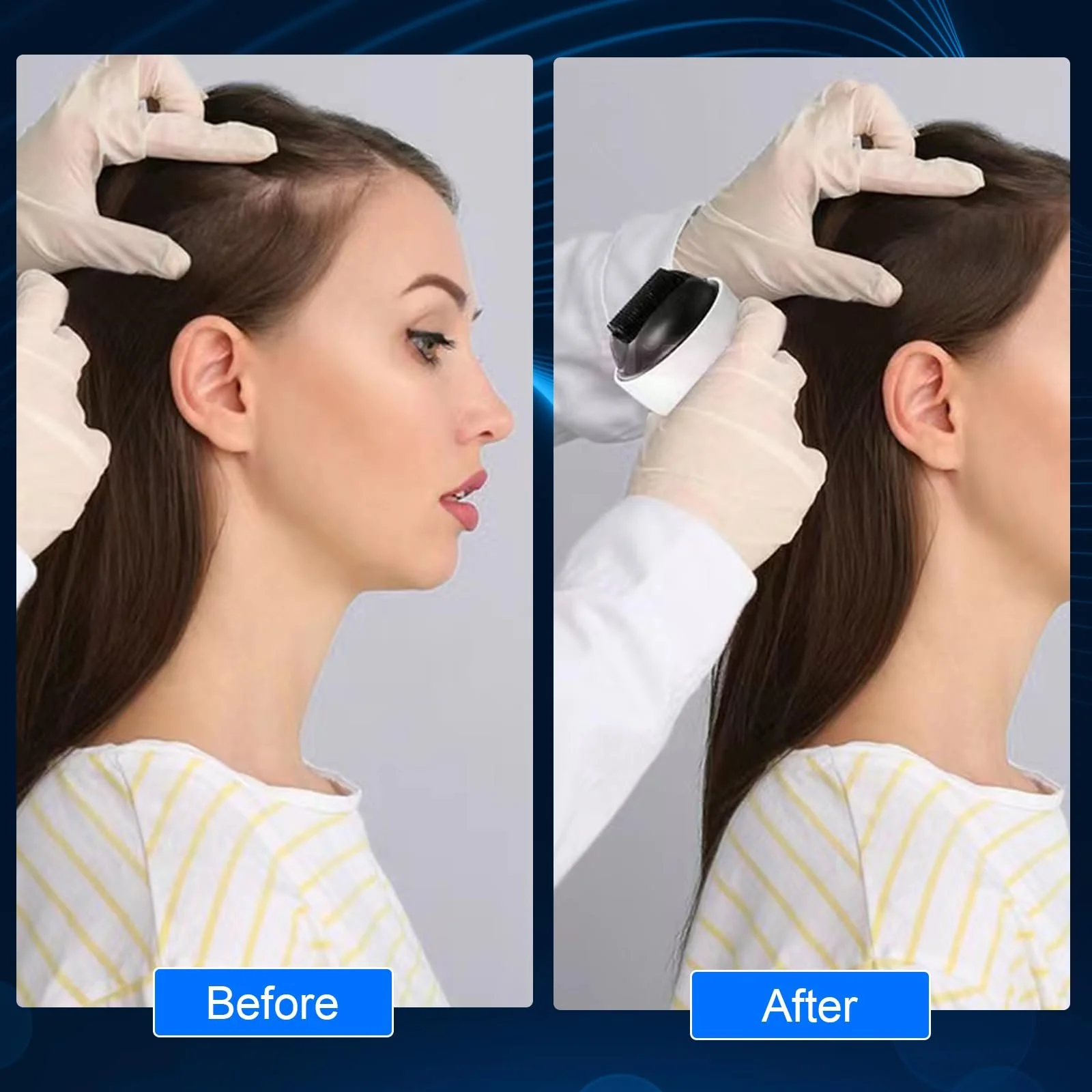 Дермаролер Professional Microneedling G4 з 1200 голками 0,5 мм, фото №6