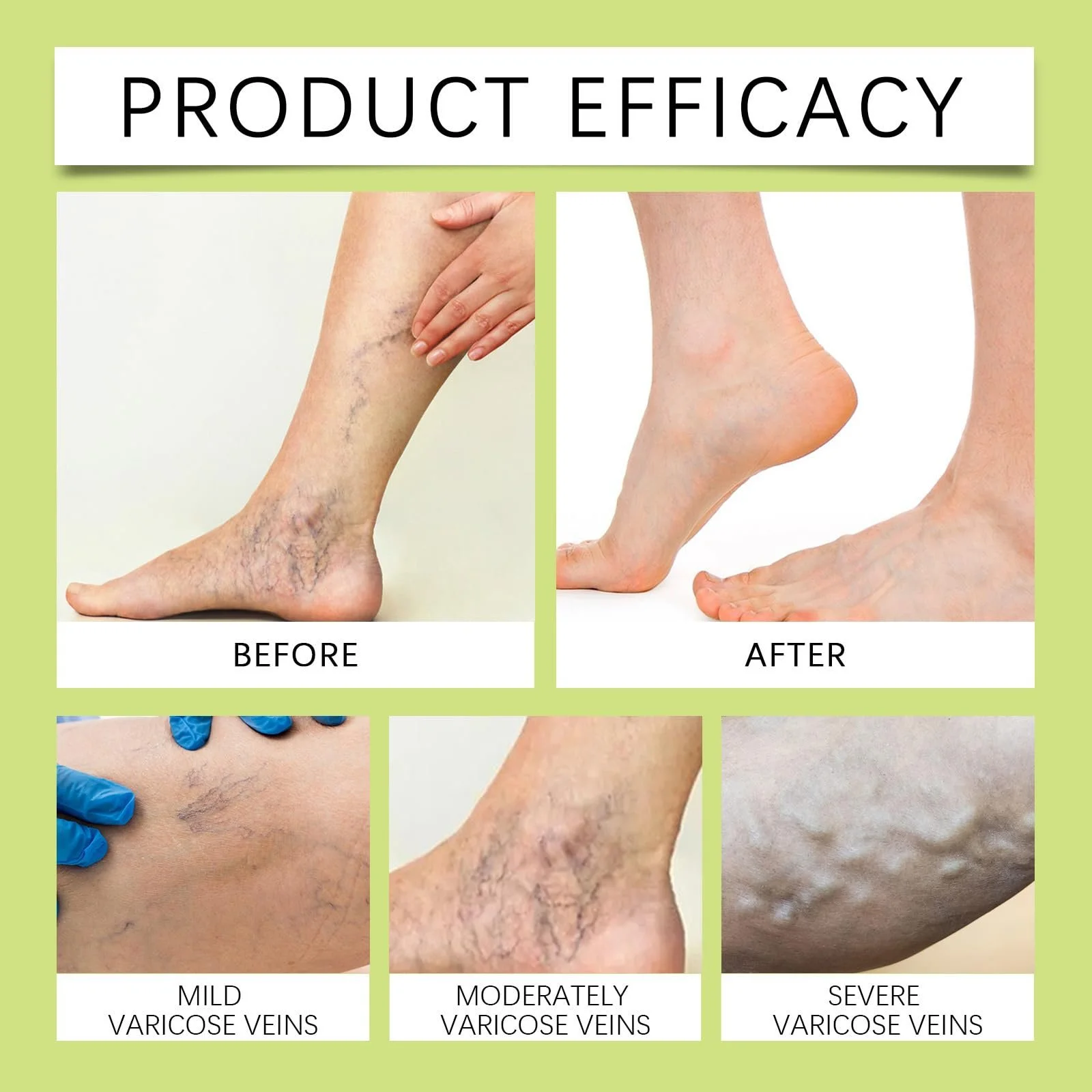 Крем для ног от варикоза успокаивающий для улучшения циркуляции кожи, фото №2 Крем для ног от варикоза успокаивающий для улучшения циркуляции кожи, фото №2