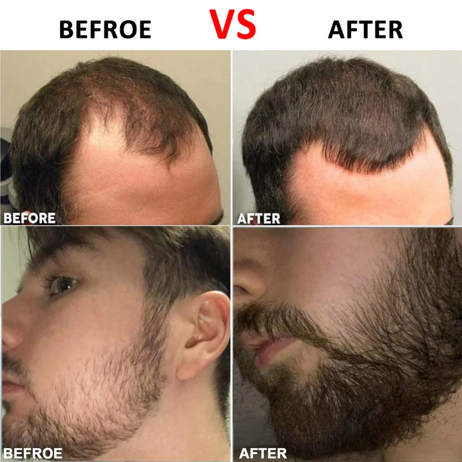 Дерма ролер LacyMC 0,5 мм, мікронідлінг ролер 540 для догляду за шкірою та волоссям, фото №6