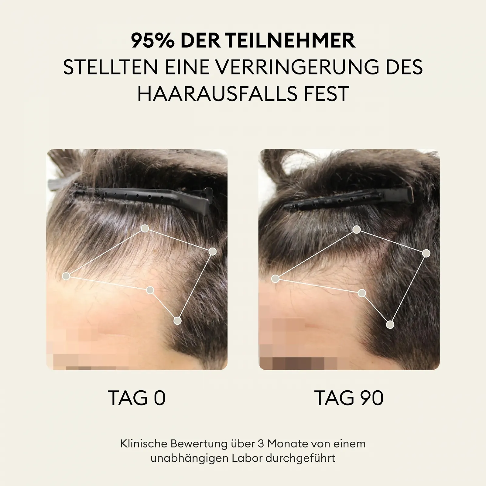 Сироватка OMA & ME 3-в-1 проти випадіння волосся та для стимуляції росту волосся, 12 флаконів по 6 мл (1 місяць лікування), фото №5 Сироватка OMA & ME 3-в-1 проти випадіння волосся та для стимуляції росту волосся, 12 флаконів по 6 мл (1 місяць лікування), фото №5