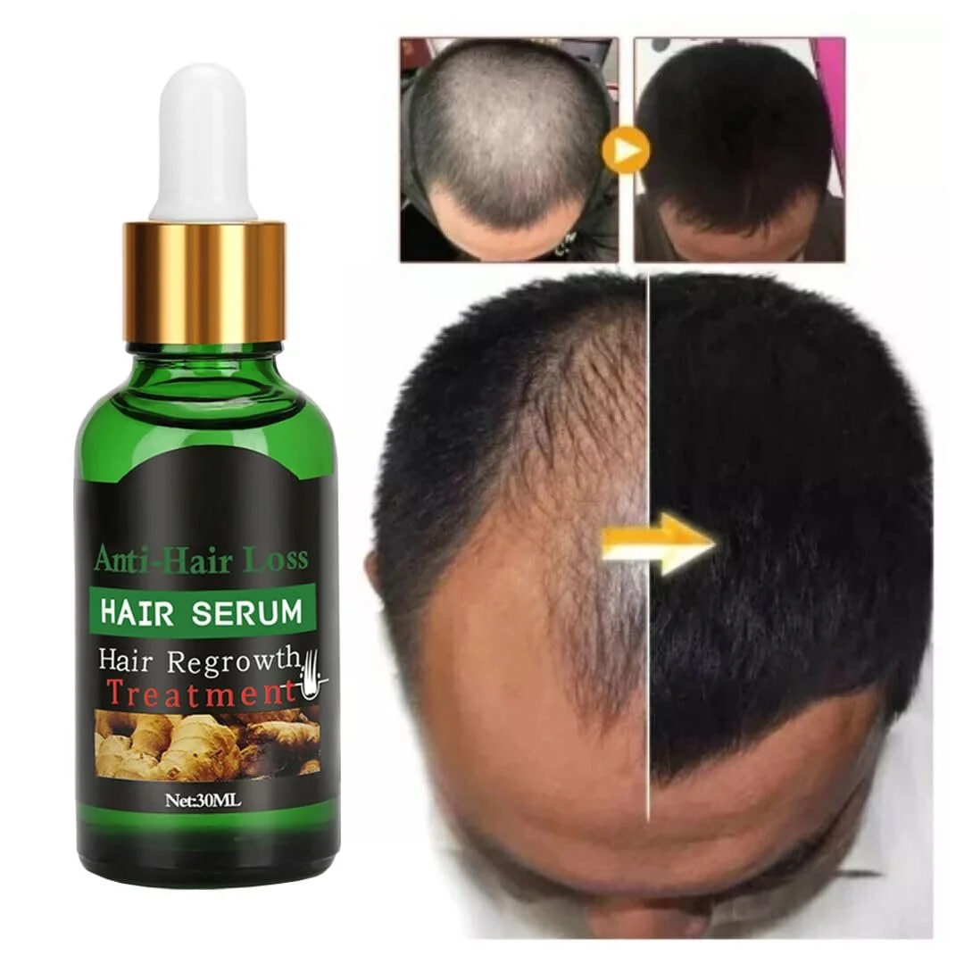 Мезоролер Youufangg з 2 наборами сироватки для росту волосся, проти випадіння волосся, фото №2 Мезоролер Youufangg з 2 наборами сироватки для росту волосся, проти випадіння волосся, фото №2